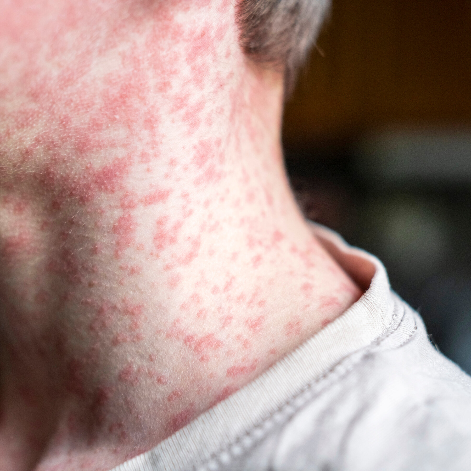 Measles Can Damage the Immune System for Years