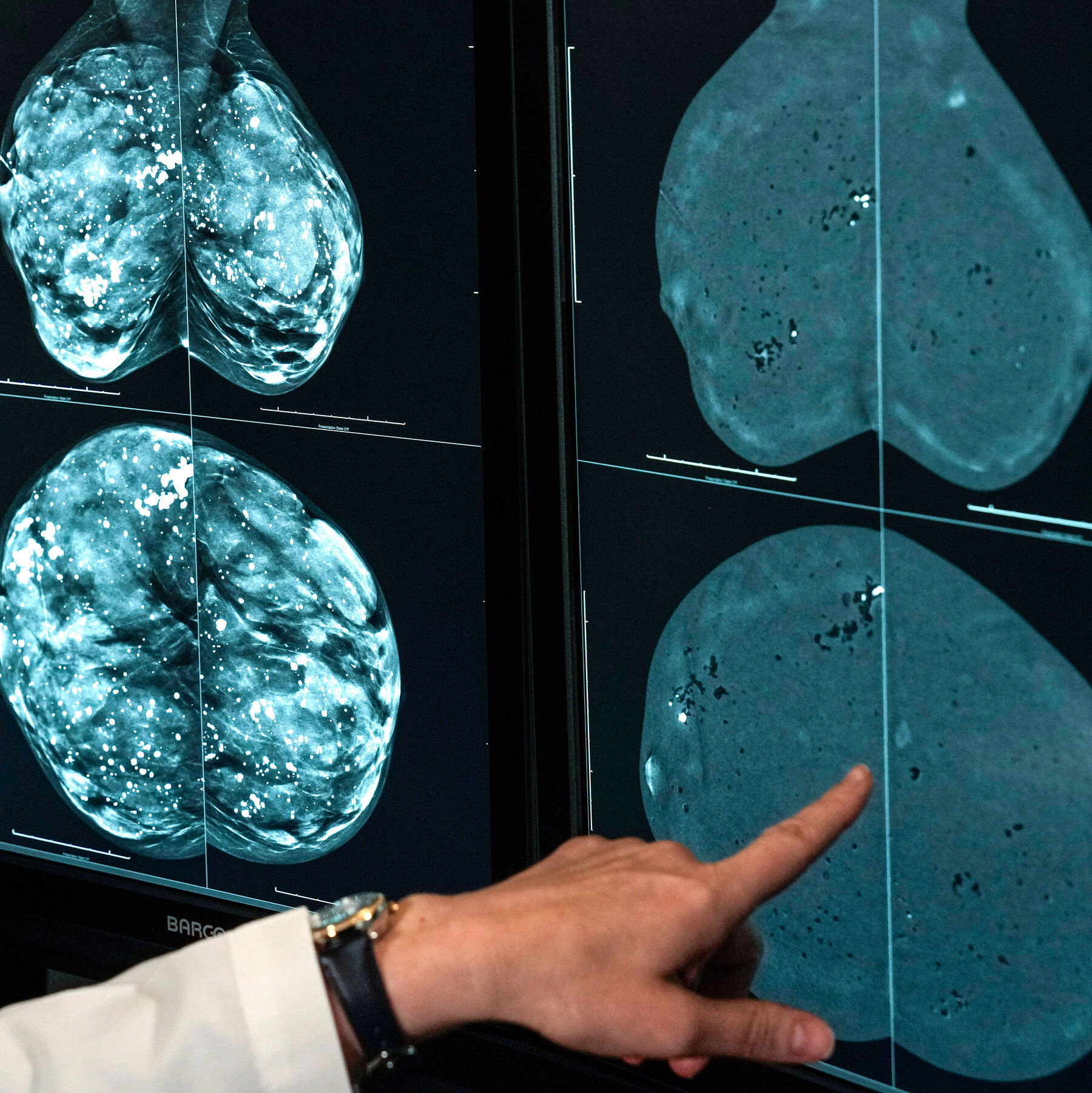 One Type of Mammogram Proves Better for Women With Dense Breasts