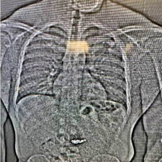 Police Recover Diamond Earrings Worth $769,500 That Thief Swallowed